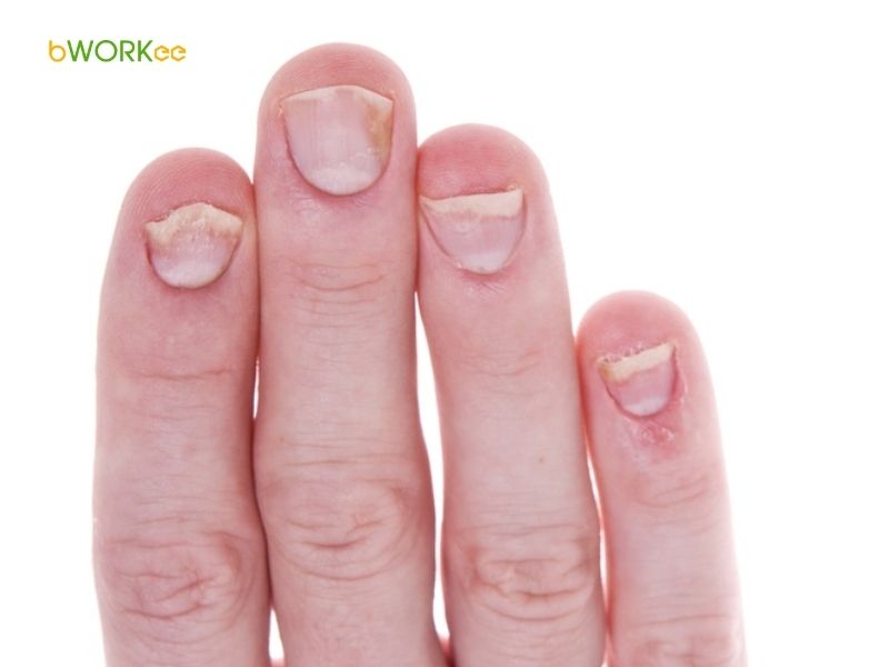 Khiến móng mọc quặp, móng chọc thịt