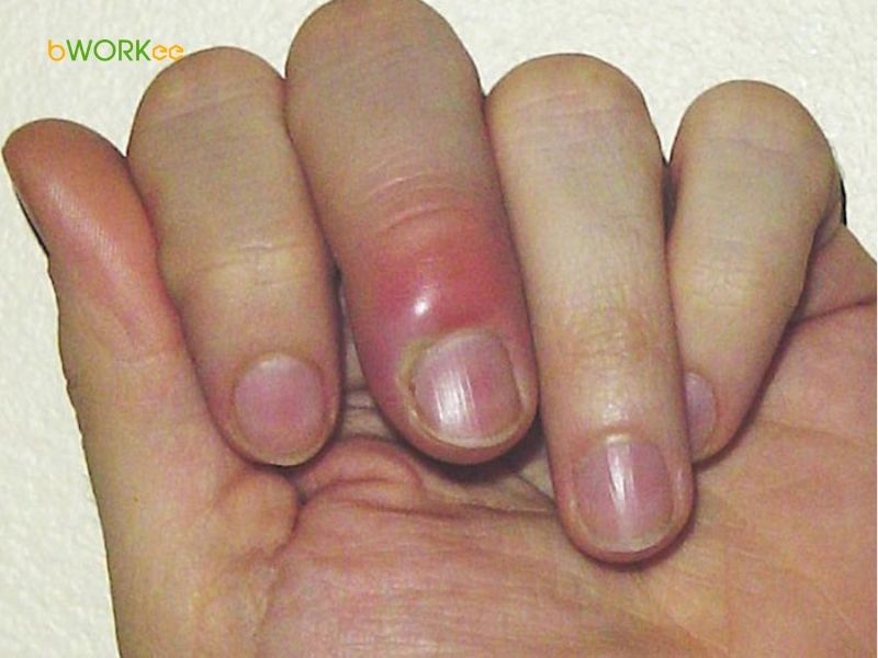 Nguy cơ cao gây nhiễm trùng (Viêm, sưng tấy)