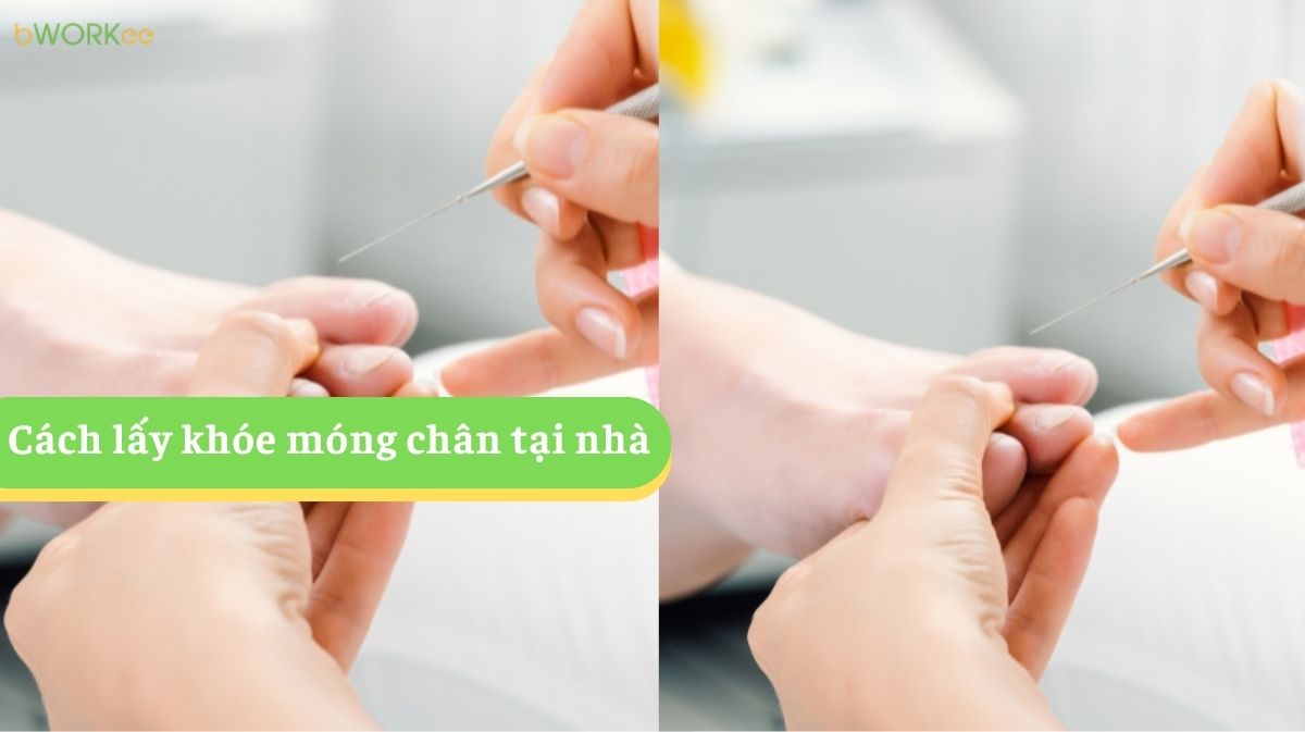 Cách Lấy Khóe Móng Chân Tại Nhà An Toàn – Giảm Đau, Ngừa Viêm Hiệu Quả
